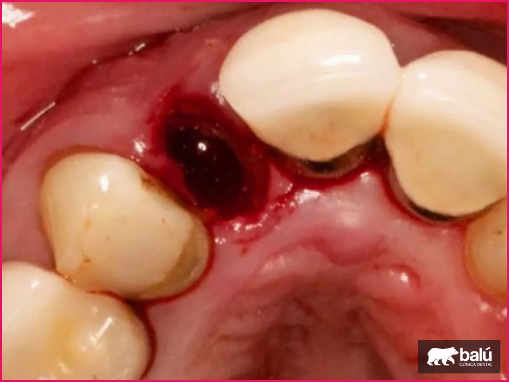 Alveolitis dental: qué es y cómo se trata