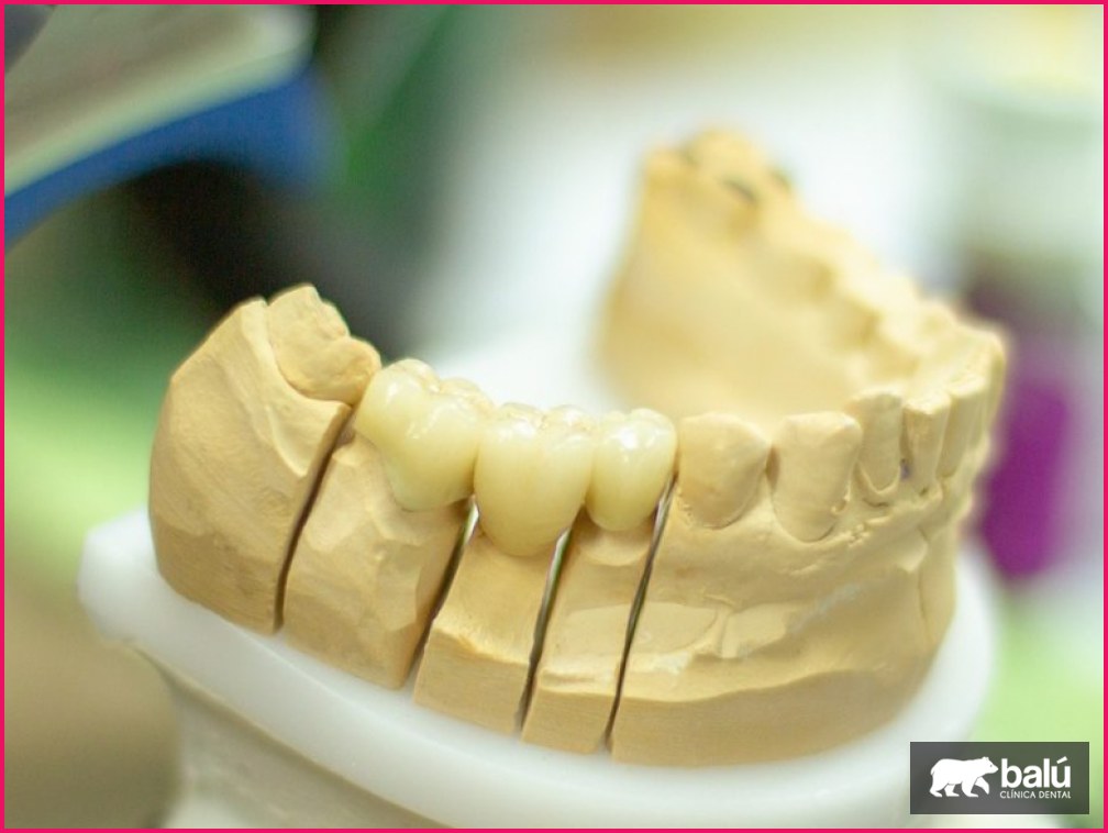 Alternativas a los implantes dentales
