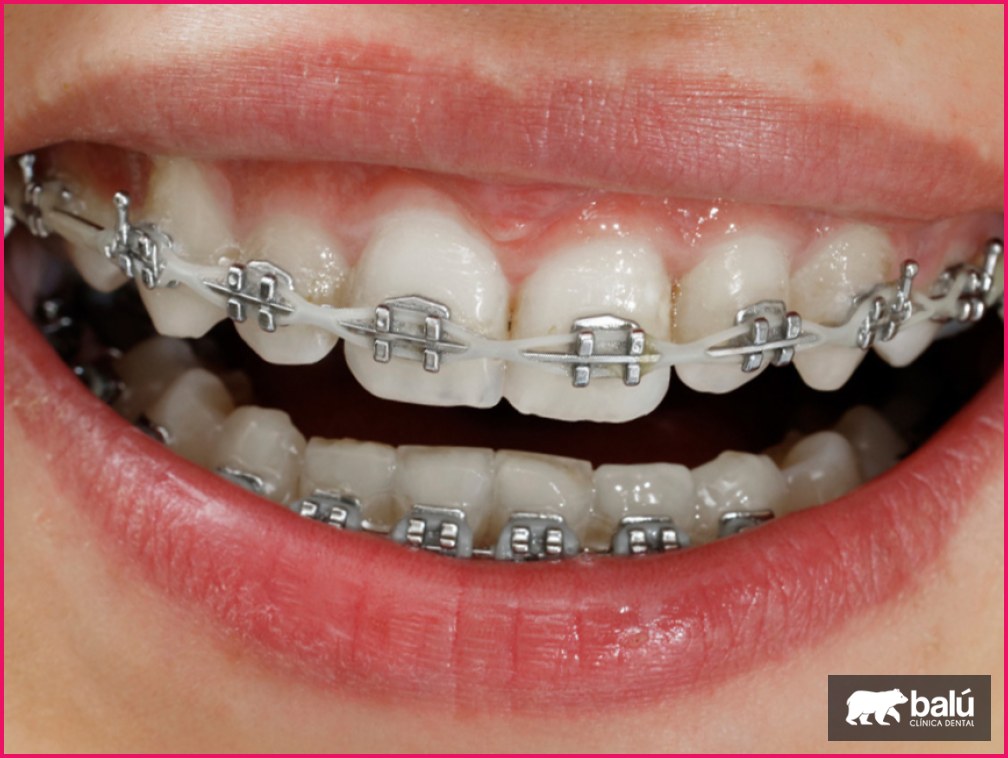 ¿Se puede hacer una radiografía con brackets?